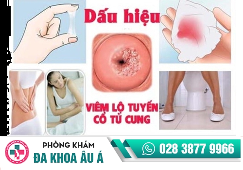 Ra máu khi quan hệ do viêm lộ tuyến tử cung